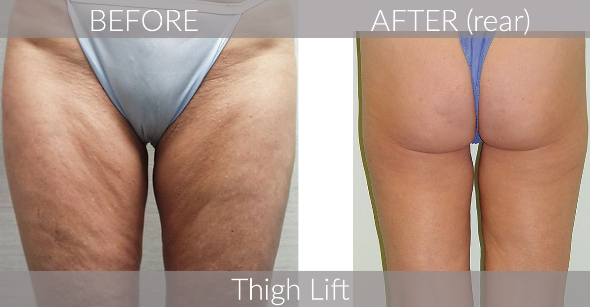 Thigh Lift Cosmetic Surgery in Morgantown, WV and surrounding