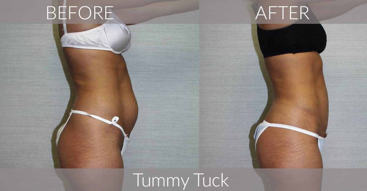 Tummy Tuck - Dr. G Cosmetic Surgery