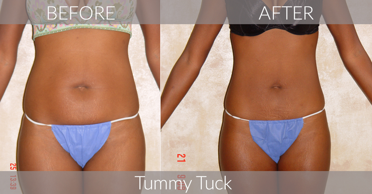 How Long Does it Take to Get a Flat Stomach?, Cosmetic and General  Dermatology located in Covington and Hammond, LA